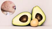 No tires el carozo de la palta: puedes utilizarlo para eliminar el acné de tu cara