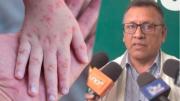 Hipótesis: Caso cero de sarampión habría llegado a Bolivia en congreso religioso