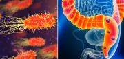 Esta bacteria podría aumentar el cáncer de colon en menores de 50 años