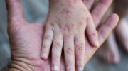 Bolivia emite alerta nacional por sarampión ante aumento de contagios y casos confirmados en Santa Cruz y El Alto