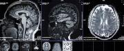El cerebro puede envejecer más rápido que el cuerpo