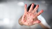 Sedes La Paz emite alerta epidemiológica por sarampión debido a dos casos confirmados en El Alto