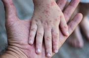 En lo que va del año, Sedes descarta 20 casos sospechosos de sarampión en Sucre