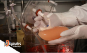 Hito: por primera vez, tratan a un paciente con un hígado fabricado en el laboratorio