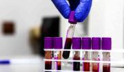 Rusia da un paso gigante con los primeros ensayos clínicos de una vacuna contra el cáncer