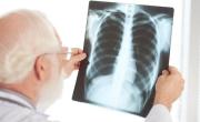 Aumentaron un 38% los casos de tuberculosis en la Argentina
