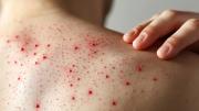 El contagio de sarampión en Bolivia aumenta: 74 casos confirmados
