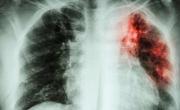 Alarma sanitaria: la tuberculosis aumentó 38% en el país