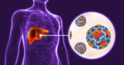 Alerta por un brote de hepatitis A en CABA y 12 provincias: ¿hay algún caso en San Juan?