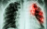 Inquieta en el país el brusco aumento de los casos de tuberculosis