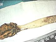 Fue al hospital por un dolor abdominal y quedó impactado: tenía un cepillo de dientes atrapado en su cuerpo desde hace 50 años
