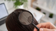 Despídete de la caspa: con este ingrediente que todos tenemos en casa tendrás una melena sana y brillante