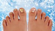 Cómo prevenir los hongos en los pies durante el invierno