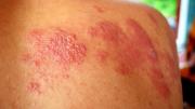 Herpes zóster: la infección que genera preocupación médica y afecta más a adultos mayores
