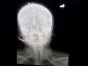 Para que tuviera un varón, un curandero le clavó un clavo en la cabeza a una embarazada