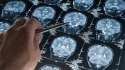 Una alianza global para combatir a las enfermedades neurodegenerativas