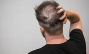 Chau calvicie: la ciencia logra hacer crecer cabello en folículos