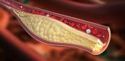 ¿No era el colesterol?: hallan una molécula en el intestino que puede cambiar la forma de tratar la ateroesclerosis