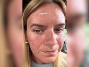 Sintió un pinchazo mientras dormía y horas después empezó a vivir una pesadilla: Fui a urgencias