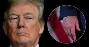 Insuficiencia venosa crónica: en qué consiste la enfermedad de Donald Trump y cómo afecta su salud