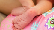 Fenilcetonuria (PKU): una enfermedad poco frecuente con consecuencias prevenibles