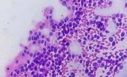 Alertan sobre el linfoma de células del manto, un cáncer poco frecuente y de difícil diagnóstico