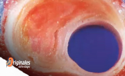 Descubrieron una nueva molécula crucial para el desarrollo de la aterosclerosis