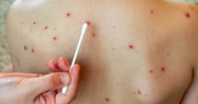 Falta de planificación propicia brotes de enfermedades como el sarampión y la coqueluche, dice epidemiólogo
