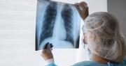 Tuberculosis: en los últimos cinco años los casos aumentaron un 65% en Argentina