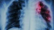 Crean test rápido y de bajo costo para diagnosticar tuberculosis