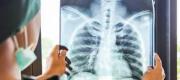 Tuberculosis: los casos se mantienen estables en Río Negro y aumentan en Neuquén