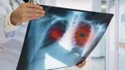 Descubren que la comida chatarra puede elevar el riesgo de sufrir este tipo de cáncer