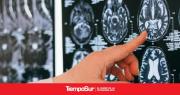 Investigadores locales identificaron un gen que mejora la recuperación tras un ACV