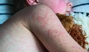 La cifra de sarampión sube a 205 en el país; Salud insiste con vacunación