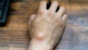 Cuál es el síntoma del cáncer que se manifiesta en las manos o en las muñecas