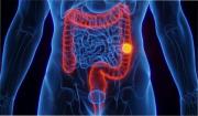 Cáncer de colon: estos son los síntomas silenciosos de la enfermedad