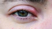 Qué significa cuando nos aparece un orzuelo en el ojo y a qué se debe