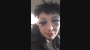 Otra paliza de la policía de Santa Cruz: esquivó un control y lo dejaron al borde de perder un ojo