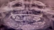El insólito caso del niño al que le quitaron más de 500 dientes en una operación