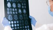 Hallazgo para frenar el Alzheimer con dos vacunas que hoy se usan para otras enfermedades