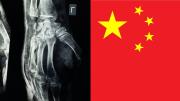 Revolución en salud: científicos en China crearon un gel que repara fracturas en tres minutos