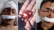 Ataque brutal: se negó a darles dinero para comprar vino y le desfiguraron la cara a ladrillazos