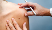 Llega a Salta la campaña gratuita para prevenir el cáncer de piel
