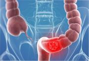 Un medicamento común puede acabar con el cáncer de colon, según un nuevo estudio