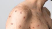 No descartan la aparición de nuevos casos de viruela del mono en Salta