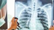 Qué es la tuberculosis y cómo se contagia: especialistas aseguran que se puede prevenir y curar