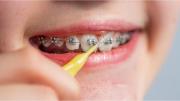 ANMAT prohibió la venta de brackets por peligro para la salud