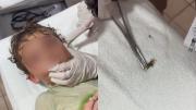 Un cangrejo entró en el oído de un niño cuando nadaba en una playa de México