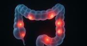 Argentina aprobó un nuevo tratamiento oral para el cáncer de colon metastásico