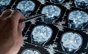 El hallazgo clave que hicieron científicos argentinos relacionado al Alzheimer con IA